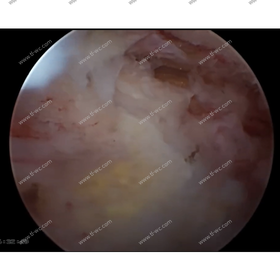 Technique Floodwood Thoracique UBE pour l'Ossification du Ligament Jaune Thoracique (OLF)