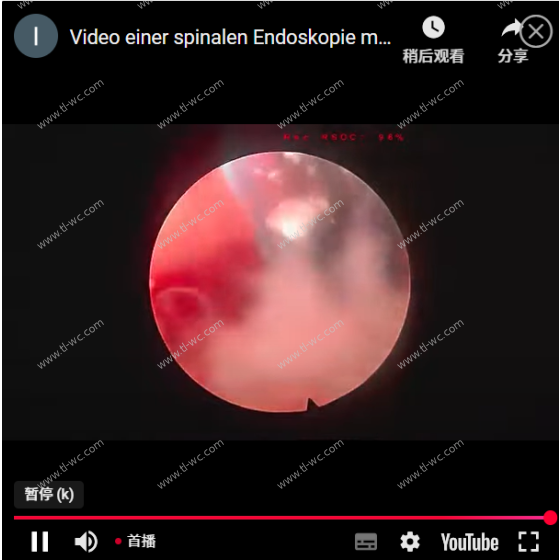 Vidéo de décompression complète à portail unique pour l'endoscope spinal