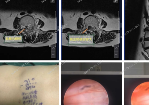 Percutaneous Endoscopic Lumbar Discectomy